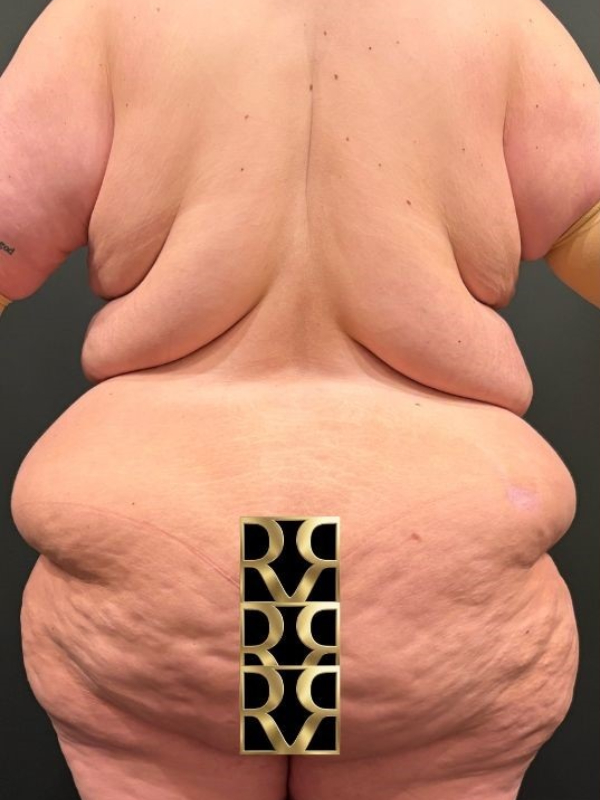 Bra Line Back Lift