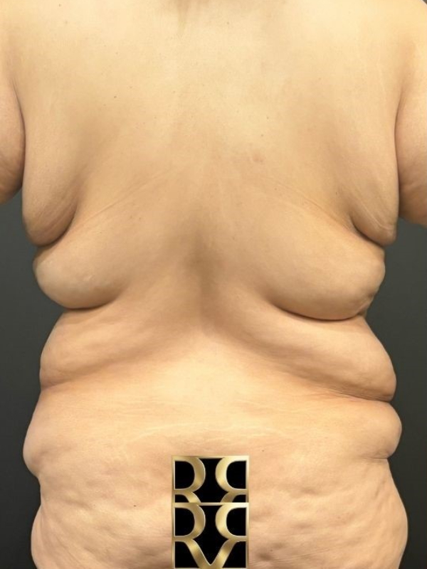 Bra Line Back Lift