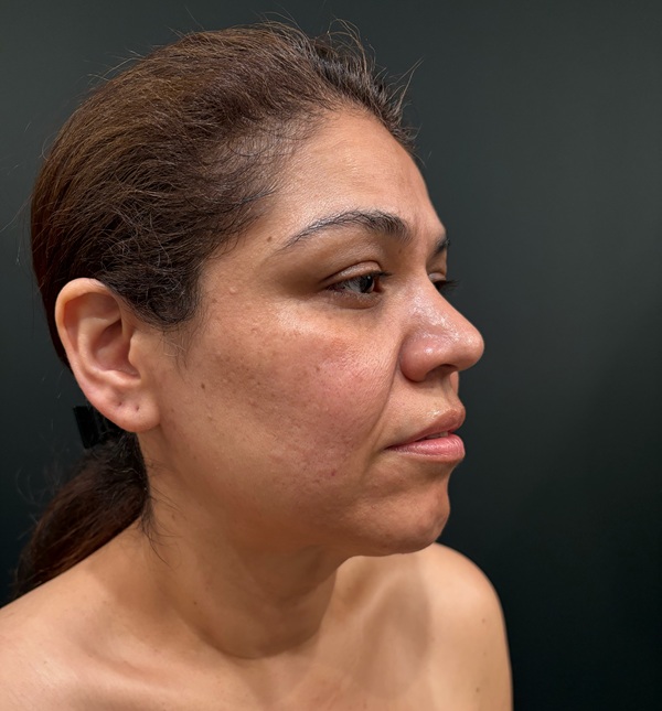 Facelift