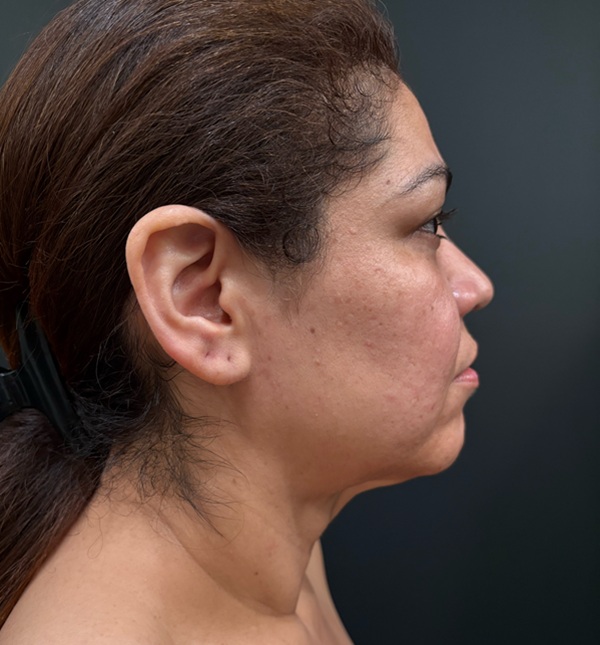 Facelift