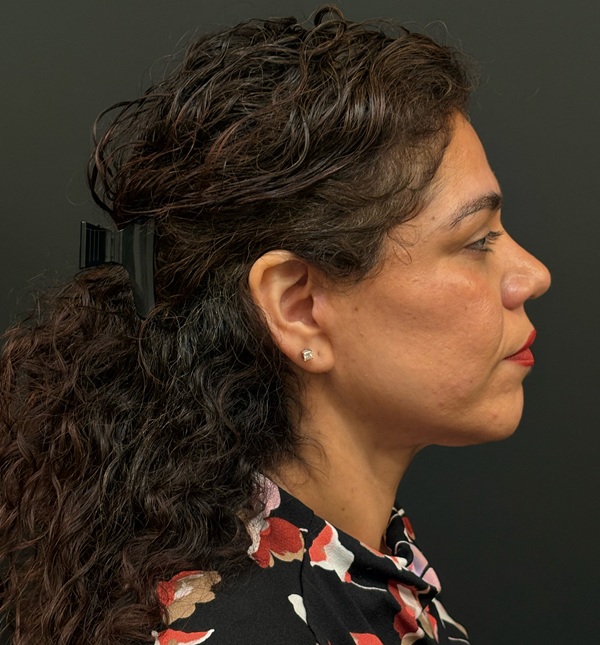 Facelift