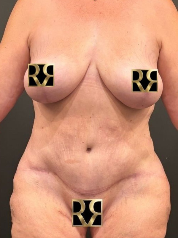 Plus-Size Tummy Tuck® & Breast Lift