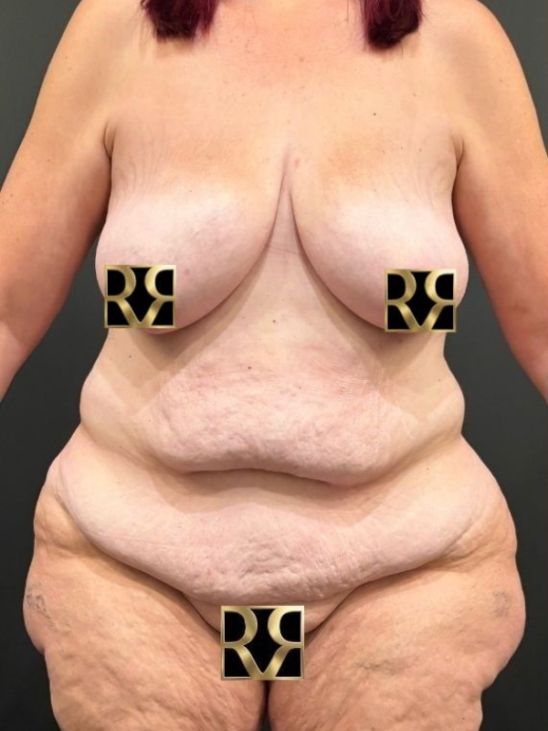 Plus-Size Tummy Tuck® & Breast Lift