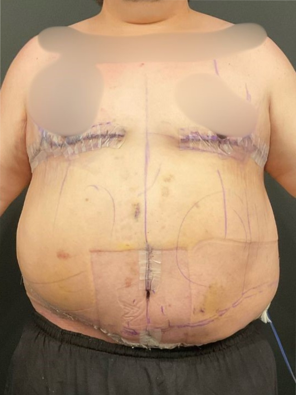 Male Tummy Tuck