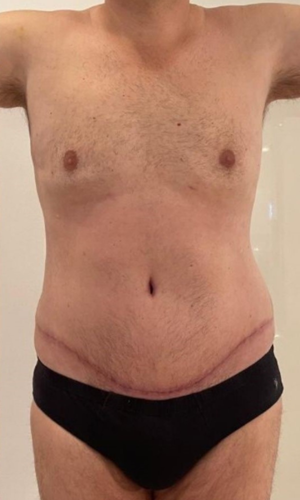 Male Tummy Tuck