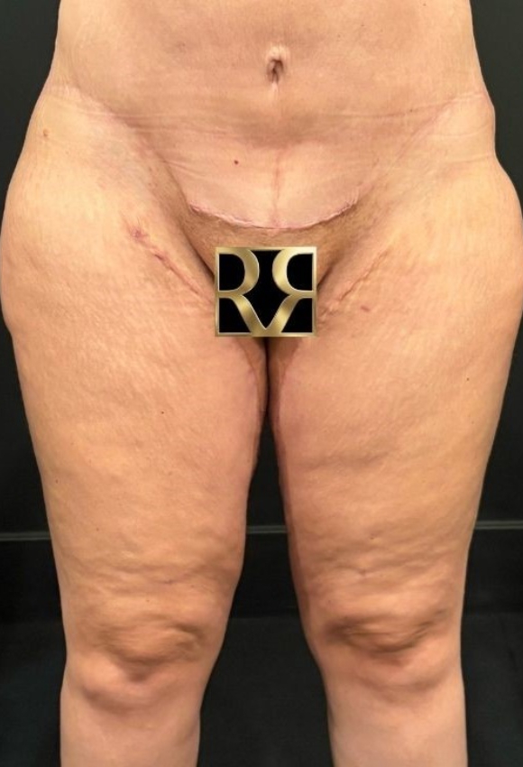 Thigh Lift