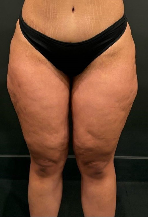 Thigh Lift