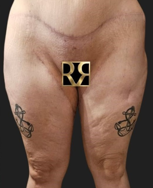 Thigh Lift