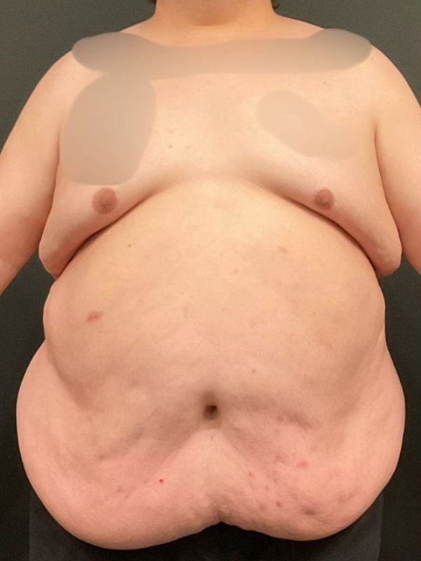Male Tummy Tuck