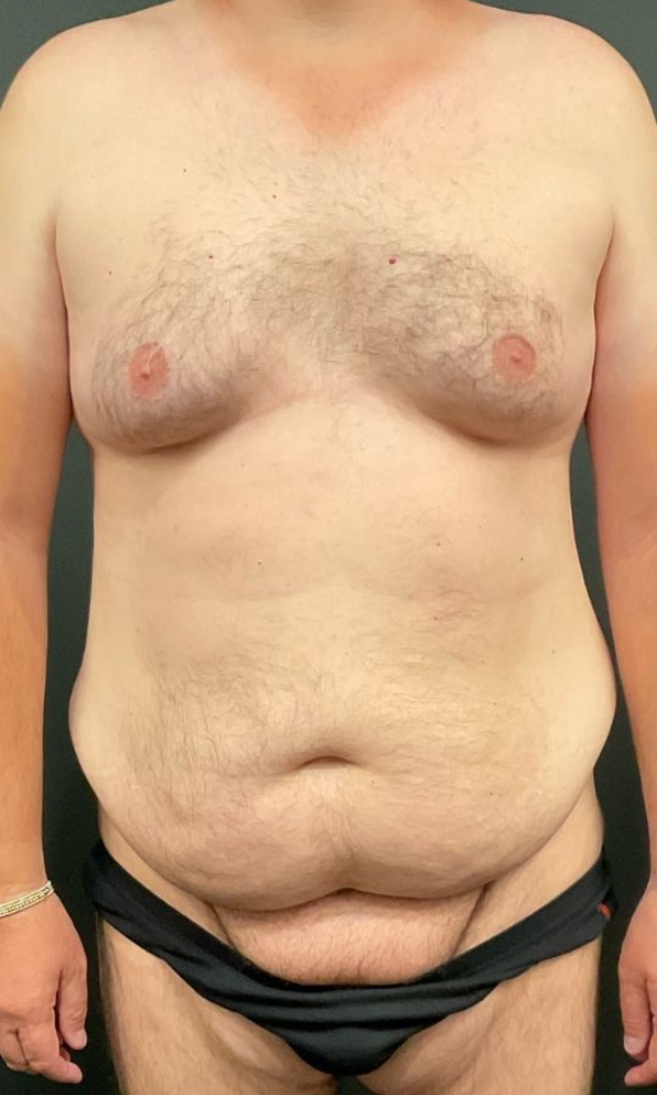 Male Tummy Tuck
