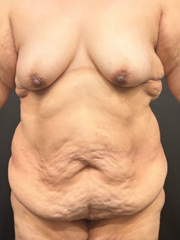 Tummy Tuck and Breast Lift