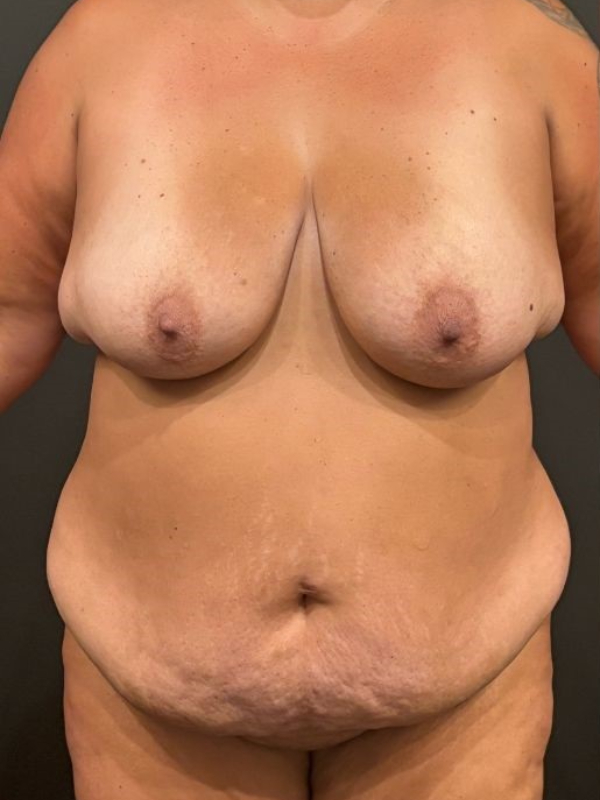 Tummy Tuck and Breast Lift