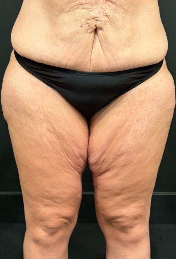 Thigh Lift
