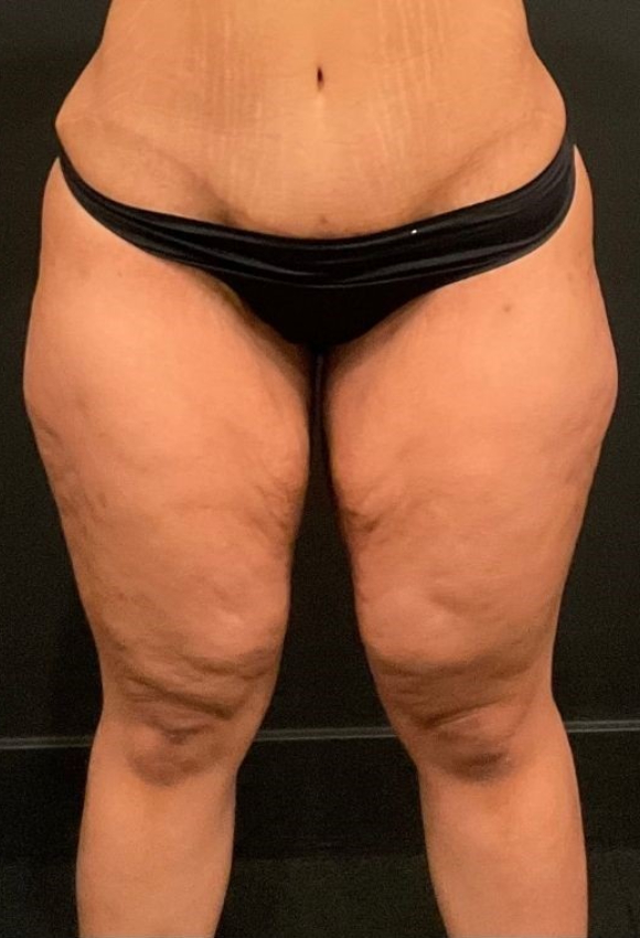 Thigh Lift