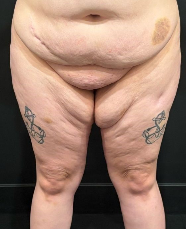 Thigh Lift