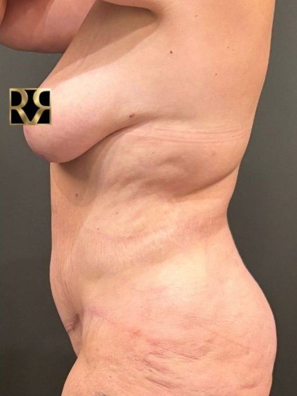 Plus-Size Tummy Tuck® & Breast Lift