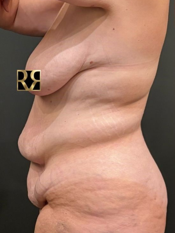 Plus-Size Tummy Tuck® & Breast Lift