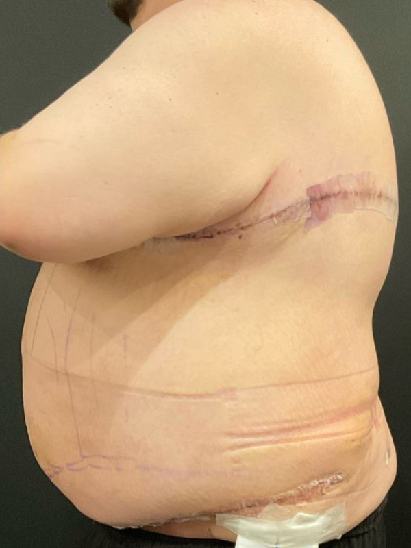 Male Tummy Tuck