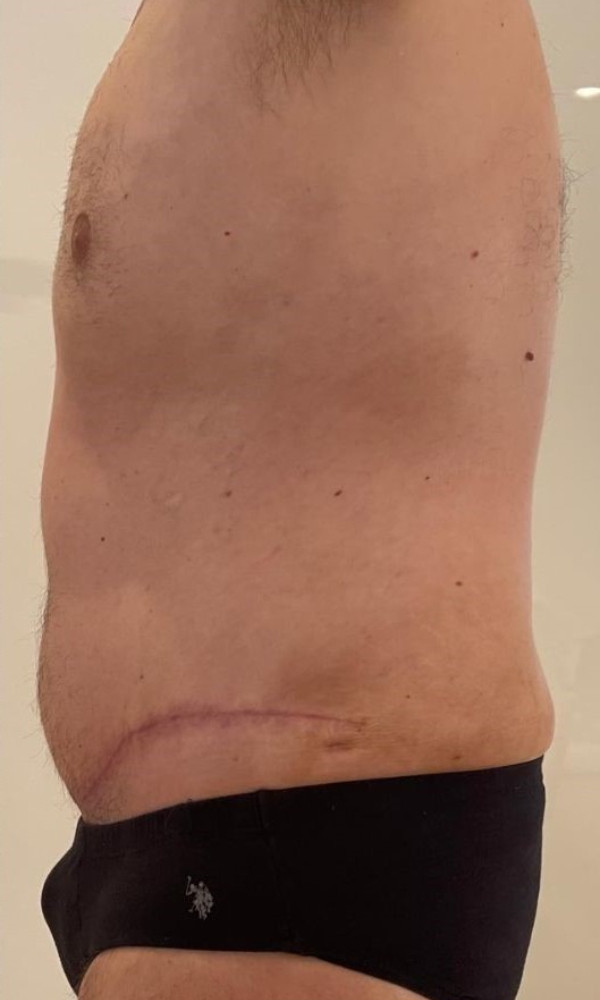 Male Tummy Tuck