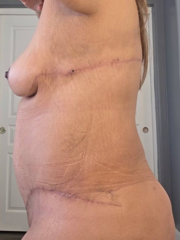 Tummy Tuck and Breast Lift