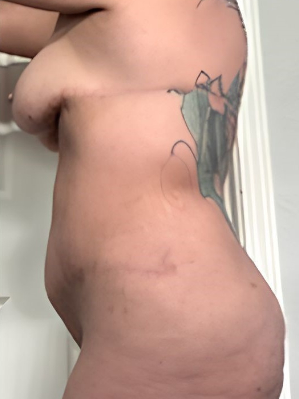 Tummy Tuck and Breast Lift