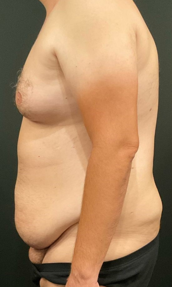 Male Tummy Tuck