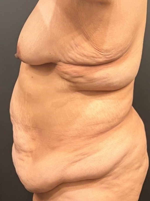 Tummy Tuck and Breast Lift