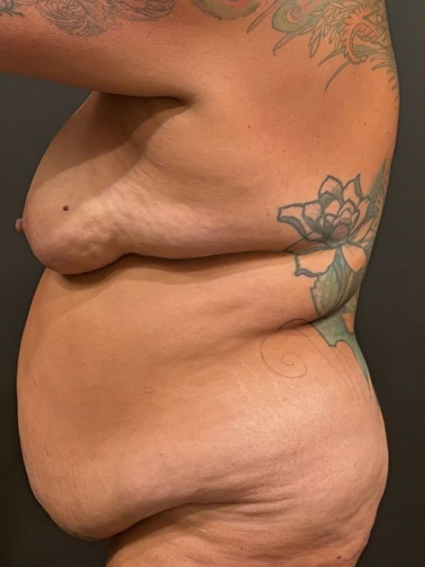 Tummy Tuck and Breast Lift