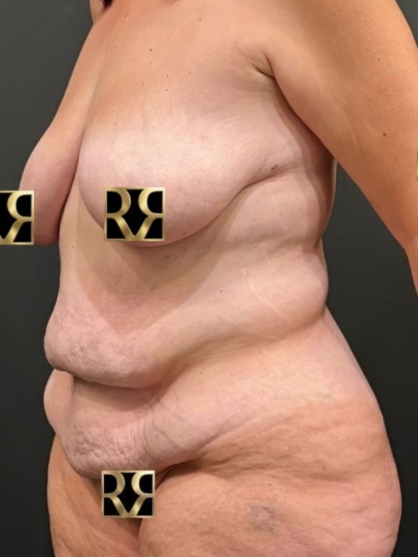 Plus-Size Tummy Tuck® & Breast Lift
