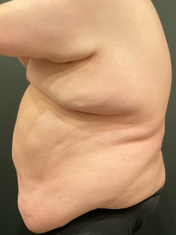 Male Tummy Tuck