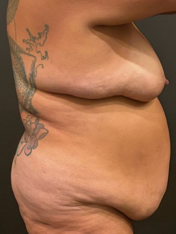 Tummy Tuck and Breast Lift
