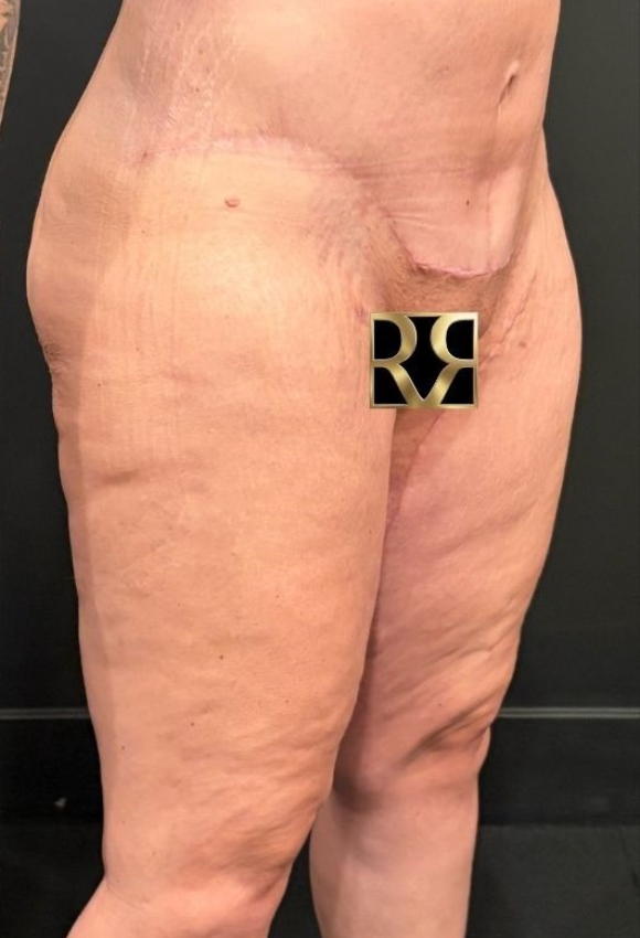 Thigh Lift