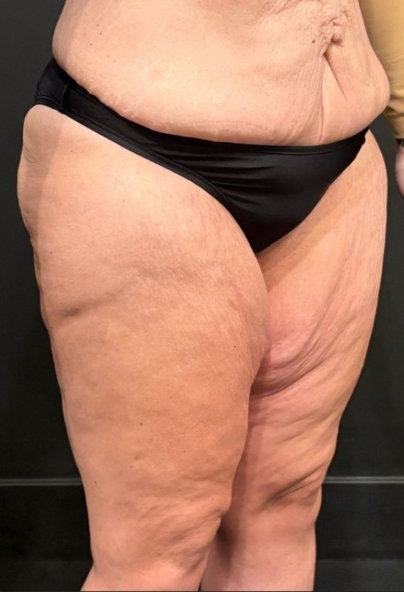 Thigh Lift