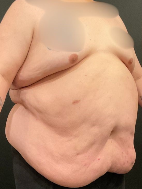 Male Tummy Tuck