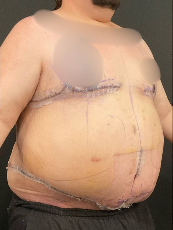 Male Tummy Tuck
