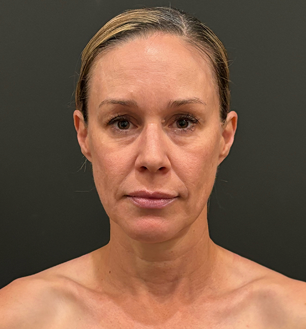 Facelift
