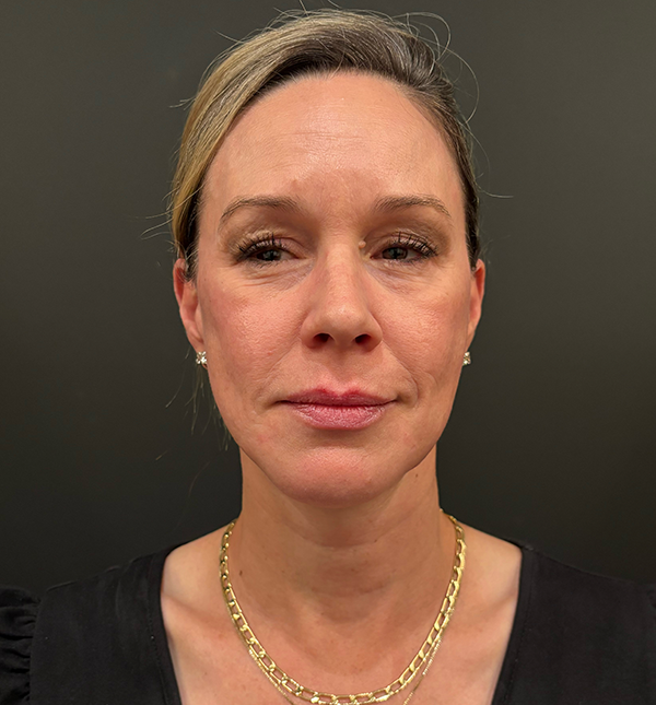 Facelift