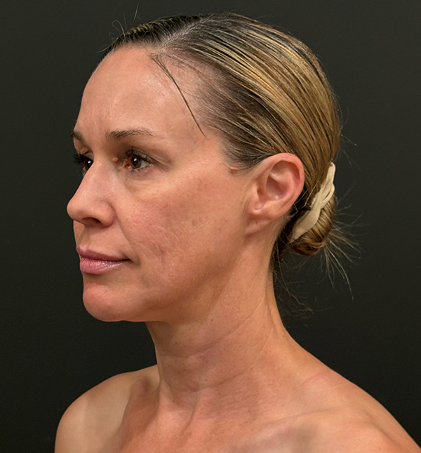 Facelift