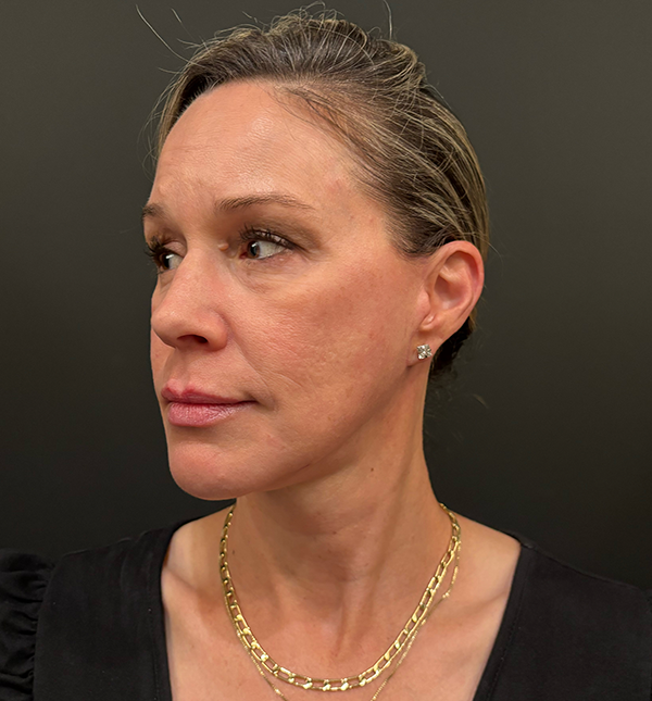Facelift