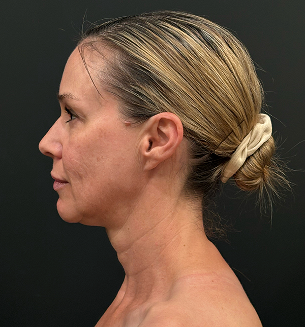 Facelift