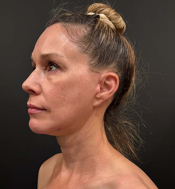 Facelift