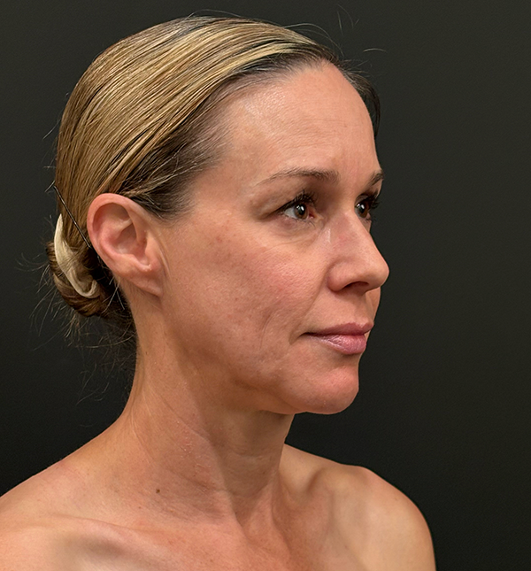 Facelift