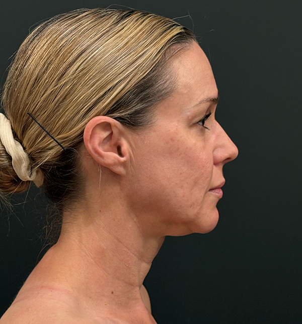 Facelift