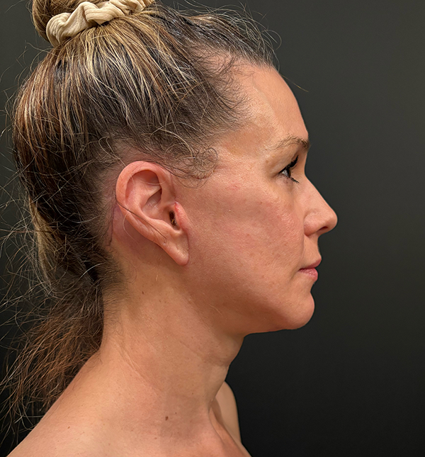 Facelift