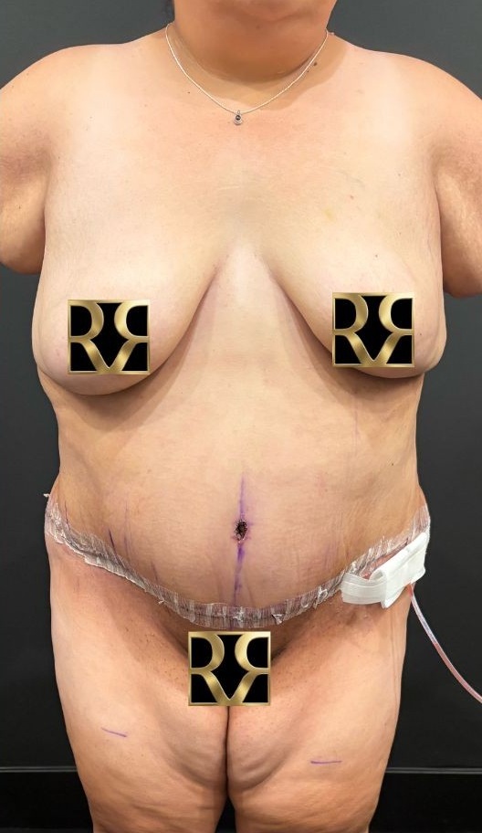 After Image: Plus-Size Tummy Tuck: Week After Surgery - front